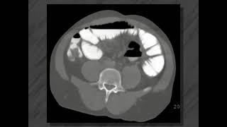 Small bowel disease  Ct enteroclysis [upl. by Ynnej]