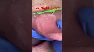 How to take impression for night guard [upl. by Dione]