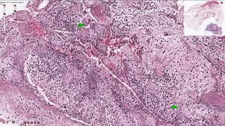 Osteosarcoma  Histopathology [upl. by Keavy779]