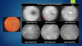 Polypoidal Choroidal Vasculopathy [upl. by Emanuela]