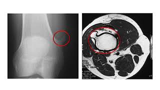 Bone Tumors 3  Chondrogenic Tumors [upl. by Vrablik528]