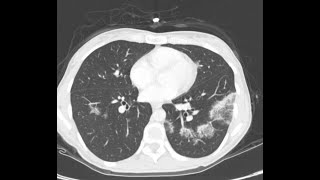 CT CHEST V11 CARDIOGENIC PUL EDEMA EOSINOPHILLIC PN SEPTIC EMBOLI AND BRONCHOPNEUMONIA lungs [upl. by Nobile]