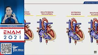 Estenosis E Insuficiencia Válvula Tricúspide y Pulmonar [upl. by Hans]