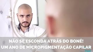 Não se esconda atrás do boné Um ano de Micropigmentação Capilar [upl. by Modla700]