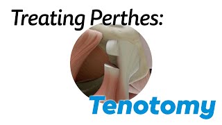 Tenotomy for Treating Perthes Disease in Children [upl. by Bergmans181]