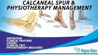 CALCANEAL SPUR amp PHYSIOTHERAPY MANAGEMENT [upl. by Malvina]