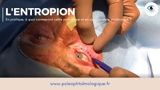 Chirurgie de lentropion Pole ophtalmologique [upl. by Huskamp]