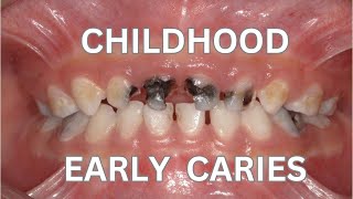 Early Childhood Caries  Rampant Caries [upl. by Ferdinanda23]