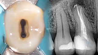 Root Canal Treatment Upper First Premolar [upl. by Anitniuq]