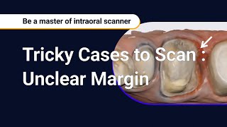 Tricky Cases to Scan  Unclear Margin [upl. by Rengaw]