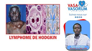 LYMPHOME HODGKINIEN  Toni Entuku  VASAVASORUM ClubMed [upl. by Nithsa168]