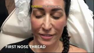 PDOTHREAD LIFT PROCEDURE BY MEDiTHREAD  Nose Lift [upl. by Hannad459]