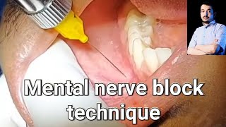 Local Anesthesia Mental Nerve block technique mandibular anesthesia Techniques dentistry [upl. by Larsen716]