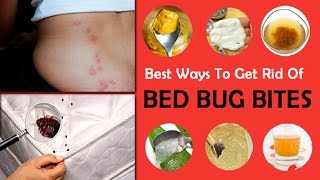 How to Treat Bed Bug Bites With Home Remedy [upl. by Anirbak192]