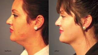 Kybella Injection for Elimination of the quotDouble Chinquot [upl. by Wallford219]