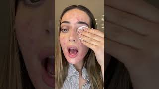 ACNE SEVERE ET MAQUILLAGE acne acnetreatment santé boutons femmeacnepositivetraitements [upl. by Areehs]