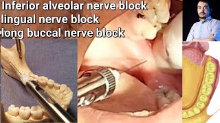 Local Anesthesia Inferior Alveolar Nerve block amp long buccal Nerves block Mandibular nerve block [upl. by Carleton]