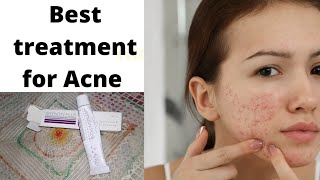 arynoin plus gel review for Acne Skin treatment acneremoval [upl. by Kristan]