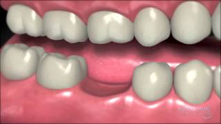 Dental Implants  Why You Should Have One [upl. by Onitsoga]