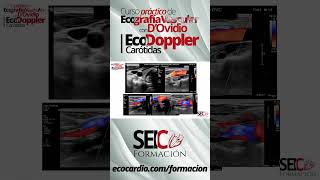 Curso Práctico de Ecografía Vascular  Eco Doppler Carótidas [upl. by Sterner]