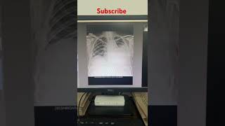 xray chest x ray PA view digital x ray machine radiology chest x ray kaise karte hai chest x ray [upl. by Fenwick]