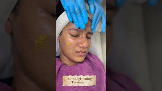 Yellow Peel Skin Lightening peelSkin Smile Clinic Bhopal ☎️ 9691918200skincare bhopal [upl. by Hwu]