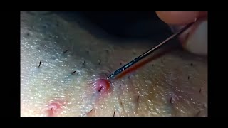 Ingrown Hair Removal [upl. by Eile]