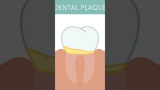 How to Remove Plaque From Teeth  dentalcare plaqueremoval shorts [upl. by Euqenimod]