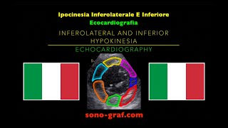 Ecocardiografia  Ipocinesia Inferolaterale E Inferiore [upl. by Ienttirb]