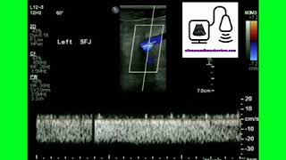 Monophasic Doppler Waveform [upl. by Ziladnerb]