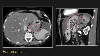 Abdominal Radiology Lecture CT of Esophageal and Gastric Pathology [upl. by Agna]