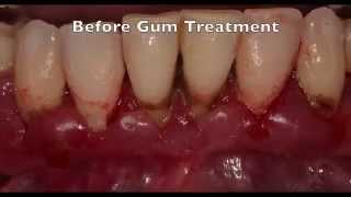 Treatment of Advanced Gum Disease Case 3 [upl. by Laaspere]