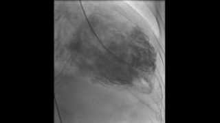 HAKIMVISTA MIOCARDIOPATIA DILATADA VENTRICULOGRAMA CON TROMBO INTRAVENTRICULAR [upl. by Azmuh336]