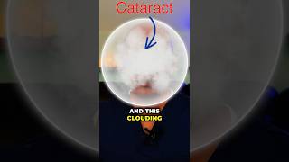 What is a cataract explained simply in 30 seconds by an eye surgeon [upl. by Terrena20]