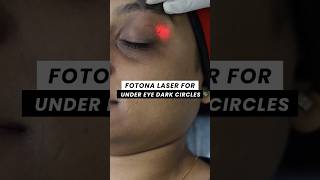 Fotona Laser for Under eye Dark Circles  ClearSkin Pune [upl. by Ettegroeg]