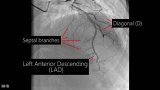 Coronary artery anatomy  Coronary angiogram [upl. by Pish790]