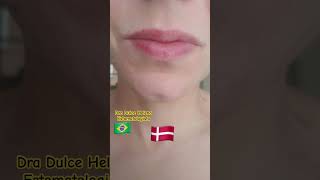 Queilite esfoliativa antes e depois Exfoliative cheilitis before and after [upl. by Rasec344]