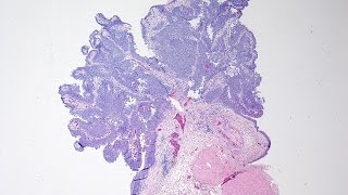 Bladder Cancer  Pathology mini tutorial [upl. by Oninotna]