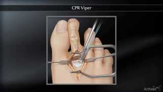 CPR Viper ™ [upl. by Gereld]