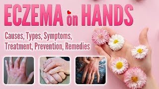 Eczema on Hands Causes Types Pictures Symptoms Treatment Natural Remedy  Hand Dermatitis [upl. by Annail420]