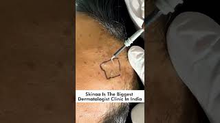 Do flat warts spread easily flatwart flat wart wartremoval skinaaskincare viral [upl. by Adnohsel]