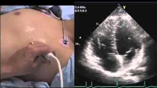 Intro to Echo Apical 4 Chamber Viewmov [upl. by Halfon]