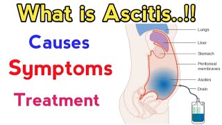 causes of ascites fluid in abdomen  treatment of ascites due to liver cirrhosis  ascites fluid [upl. by Capello]