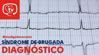 ¿Cómo se diagnostica un Síndrome de Brugada telodigodecorazón [upl. by Broddie596]