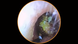 Tympanic membrane perforation and postoperative debridement for cholesteatoma 44 [upl. by Meakem]