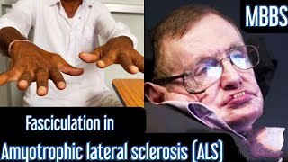 Fasciculation in Amyotrophic lateral sclerosis ALS mbbs medicine neet usmle aiims next [upl. by Yumuk]