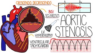 Aortic Stenosis Explained in 10 Minutes With Heart Murmur Sound [upl. by Merill]