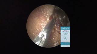 Huge dry nasal crust removal [upl. by Llewoh968]