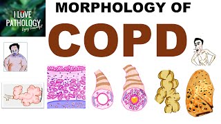 COPD Morphology Review  Emphysema Chronic Bronchitis Bronchiectasis Asthma  Exam Prep [upl. by Llenreb929]