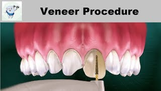 Dental Veneers Procedure Step by step [upl. by Nemajneb811]